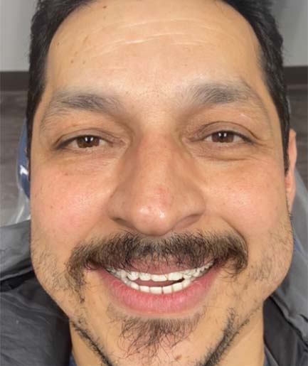 before and after smile gallery