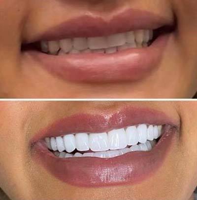 before and after smile gallery