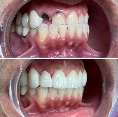 before and after smile gallery